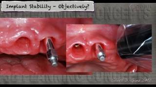 How do you know an implant is ready to be restored [upl. by Panta612]