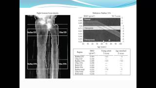 Bariatric Osteomalacia Fiona Cook MD  Internal Medicine Grand Rounds [upl. by Bencion953]