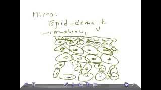 QUICK PATHOLOGY Malignant Melanoma [upl. by Dimitri]