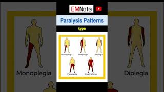 Paralysis or Weakness Patterns [upl. by Eelta]