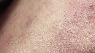 Acne on skin  Remove nose pimples  Acne Treatments Mai Ngoc 💕💕💕 [upl. by Dorothi]