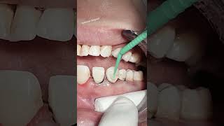 Class V composite restoration dental dentist [upl. by Tench]