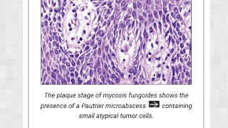 mycosis fungosis [upl. by Hallsy963]