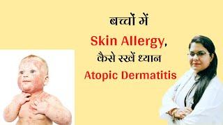 Atopic dermatitisEczema बच्चों में skin allergy कैसे रखें ध्यान [upl. by Filippo431]