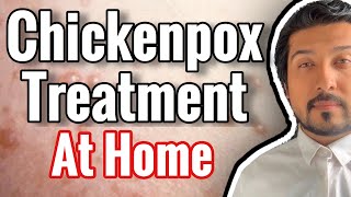 Chickenpox Treatment At Home 2020 [upl. by Cirted]