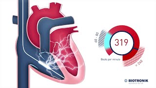 Implantable Cardioverter Defibrillator  How it works [upl. by Adle]