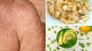 3 Natural Remedies for Treating Tinea Versicolor at Home Pityriasis Versicolor [upl. by Ettevol530]