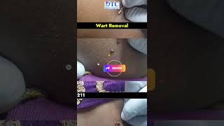 Safe and Effective Wart Removal Treatment [upl. by Ileak]