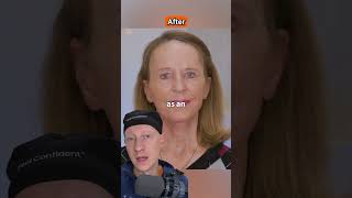 AMAZING Facelift amp Laser Resurfacing Transformation  Plastic Surgeon Reacts [upl. by Nave]