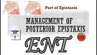 Management of Posterior Epistaxis — Part of Epistaxis [upl. by Lyell]