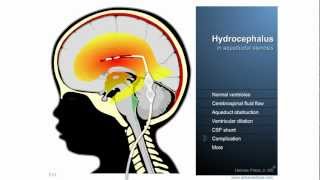 Hydrocephalus  Definition treatment and complications [upl. by Yanahs819]