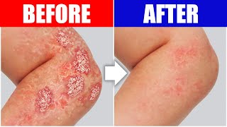 Psoriasis Relief The Best Remedy For Your Skin [upl. by Domenico]