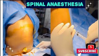 Spinal Anaesthesia technique howto doctor mbbs medicine anaesthesia youtubevideos [upl. by Nirrad]