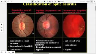 Papilledema and Papillitis 3 [upl. by Scuram]