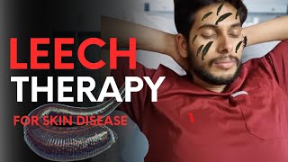 Leech therapy to cure skin diseases 😮 A natural approach of healing  doctorduo [upl. by Enenaej]