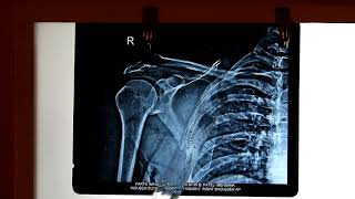 Radiological Anatomy of Upper limb [upl. by Wadlinger119]