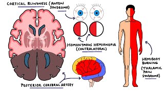 Posterior Cerebral Artery Stroke Syndromes  PCA Stroke Syndromes  Stroke Syndromes [upl. by Ranson]