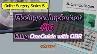 Placing an Implant at 16 Using OneGuide with GBR [upl. by Eelta]