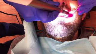 Sculpt IQ dental diode laser Soft Tissue Procedure Photobiomodulation – Dr Shalin Shah [upl. by Babita]