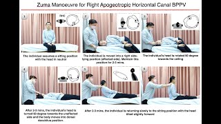 Zuma Manoeuvre for Right Apogeotropic Horizontal Canal BPPV [upl. by Messing800]