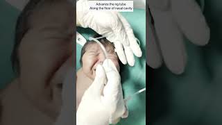 NG tube  feeding tube insertion in a newborn  pediatrics newborn shorts thebabydoctor [upl. by Jarv]