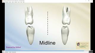 Orthodontics Crossbite المرحلة الخامسة [upl. by Enois]