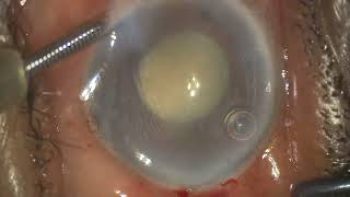 Surgical management of phacomorphic glaucoma with zonular weakness [upl. by Ahcire]