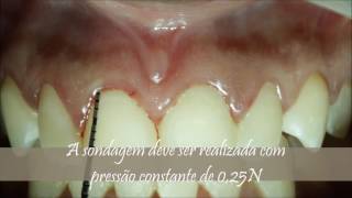 Caso clínico de sondagem periodontal [upl. by Spiers]