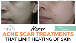 Extensive Treatment of Acne Scars while Reducing Excessive Heat from Lasers [upl. by Chaffin]