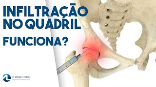 BURSITE DO QUADRIL Infiltração funciona [upl. by Normandy]