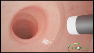 Revisão da Cirurgia Bariátrica do Tipo Bypass Via Gastroplastia Endoscopica [upl. by Aysan]