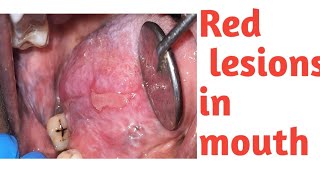 Red lesions in Oral cavity What could be these red lesions Erythroplakia क्या होता है erosive Lp [upl. by Nirhtak]