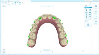 CLINCHECK MODIFICATION TO SUCCEED [upl. by Bernadina122]