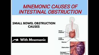 MNEMONIC CAUSES OF INTESTINAL OBSTRUCTION medicinelectures medicineeducationtalks medilectures [upl. by Schellens]