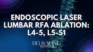 Endoscopic Laser Lumbar RFA Ablation L45 L5S1 [upl. by Rexanne]