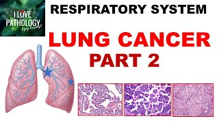 LUNG CANCER  Part 2 Morphology Clinical features [upl. by Aikenat]