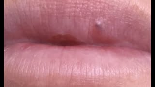 Relaxing Lips Blackheads Extraction Tiktok Compilation 10 [upl. by Izak]