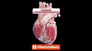 BLOQUEO AURÍCULOVENTRICULAR  MOBITZ I y II  OneCuteMedic [upl. by Patnode]