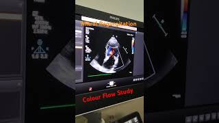 Colour Doppler Show In Echo echo cardiology [upl. by Elwin]