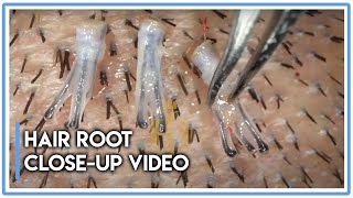 Hair root closeup Video hairtransplantfuemethodlaowalens [upl. by Asamot]