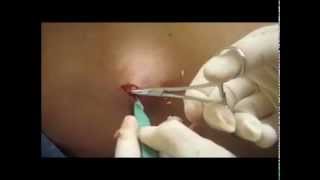 Cyst Removal NYC  212 6449494  NYC Cyst Removal  New York NY [upl. by Adnilreh667]