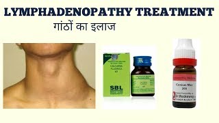 LYMPHADENOPATHY TREATMENTगांठों का ईलाज [upl. by Kailey]