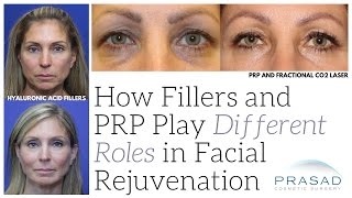 How Fillers and PlateletRich Plasma PRP Play Different Roles in Facial Rejuvenation [upl. by Askwith]