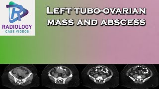 Left tuboovarian mass and abscess [upl. by Nabe]