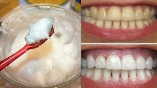 How To Whiten Your Yellow Teeth Naturally At Home दांत चमकानाTooth Whitening [upl. by Kcirdled]