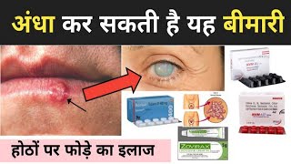 What is Herpes simplex Herpes Treatment in Hindi 👈 हर्पीज़ के कारण 👈 होठों पर फोड़े का इलाज 👈 Medic [upl. by Oglesby]