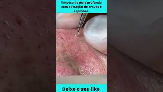 😃 limpeza de pele profunda com extração de cravos e espinhas  cravos e espinhas 😃😉 [upl. by Redwine]