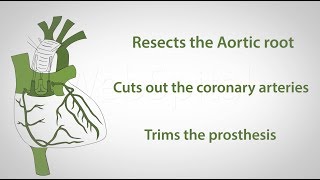 Yacoub operation aortic valve repair [upl. by Grey749]