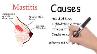 Mastitis  Breast pain during lactation or pregnancy Mastitis symptoms and treatment [upl. by Blanka]