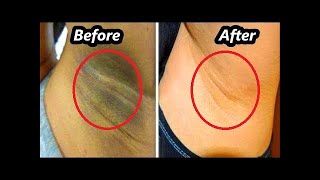 Amaira Skin Lightening Serum Reviews  Does it Work [upl. by Llenrahc]